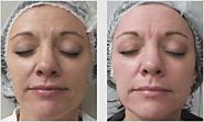 Achieve youthful Radiant skin through BBL laser treatment Skin111 Dubai