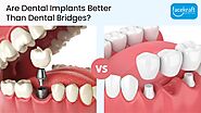 Are Dental Implants Better Than Dental Bridges? - Face Kraft Clinic