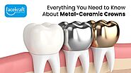 Everything You Need to Know About Metal-Ceramic Crowns