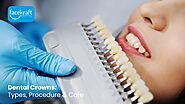 Dental Crowns: Types, Procedure & Care - Face Kraft Clinic