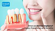 What are Dental Implants? Types, Procedures and Benefits - Face Kraft Clinic