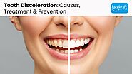 Tooth Discoloration: Causes, Treatment & Prevention - Face Kraft Clinic
