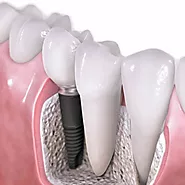 Dental Implants | Everbright Smiles