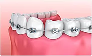 Best Invisalign Braces Dentist Pune