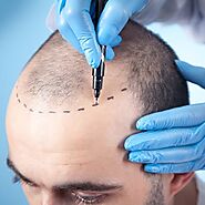 How Do FUE And FUT Hair Transplants Differ From One Another?