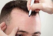 Best Hair Transplant in Jaipur - Hair Transplant Cost in Jaipur