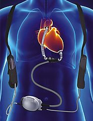 Modern Trends in Heart Surgery