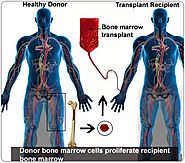 Affordable Bone Marrow Transplant in India