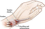 Wrist Injuries