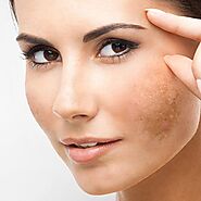 “Say Goodbye to Skin Imperfections: Experience the Miraculous Cosmelan Peel in Dubai!” – Dynamic clinic