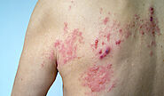 The Best Shingles Treatment for Healing a Herpes Zoster Infection Fast