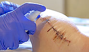 Best Wound Treatment for Fast Healing & Infection Prevention