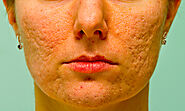 Acne Scars: Causes, Diagnosis, Types & The Best Treatment