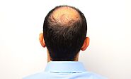 ViaDerma to Enter The $5 billion Global Hair Restoration Market with Innovative Hair Regrowth Product in 2023 - Men's...