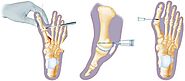 minimally invasive foot surgery