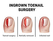 ingrown toenail treatment