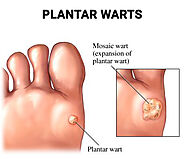 plantar warts treatment