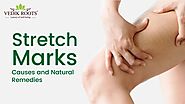 Bye-Bye Stretch Marks: Causes and Natural Remedies – Vedikroots