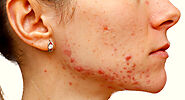 Cystic Acne: Causes, Symptoms & The Best Treatment