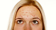 Hormonal Acne: Causes, Signs & The Best Treatment