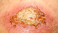 Infected Cuts: Learn How to Identify & Treat Them Fast to Prevent Complications