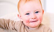 Baby Eczema: The Causes, Symptoms & Best Treatments for Fast Relief