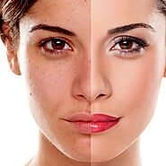 How to Find Affordable Pigmentation Treatment in Dubai | TheAmberPost