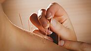 Professional Acupuncture Care in London | London Osteopathy & Pilates