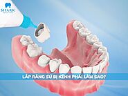 Nguyên nhân lắp răng sứ bị kênh và cách khắc phục hiệu quả