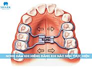 Nong hàm khi niềng răng là gì? Các trường hợp cần nong hàm
