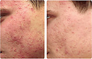 Best Acne Scar Removal Laser Treatment in Bangalore