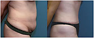 Weight Loss Treatment in Bangalore - Radiance Medispas