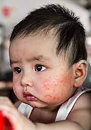 "Eczema Treatment for Babies and Children: Expert Tips for Parents in Dubai" | TechPlanet
