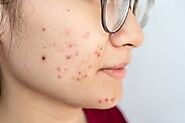 "Eczema in Adults: Treatment Options and Success Stories in...