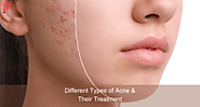 Different Types of Acne & Their Treatment | Pen To Point