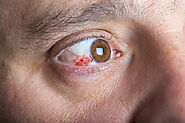 What happens when there’s blood in your eye? -