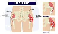 Physical Therapy for Hip Pain NYC