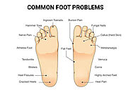 Physical Therapy For Foot In NYC