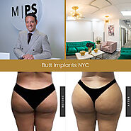 Butt Implants NYC