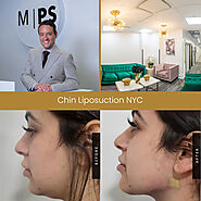 Chin Liposuction in NYC