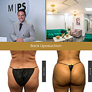 Back Liposuction New York City