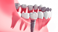 Important Factors to Consider Before Getting Dental Implants