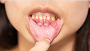 Canker Sores vs. Cold Sores: What You Need To Know