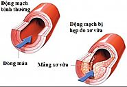 Triệu chứng và nguyên nhân gây xơ vữa động mạch cần lưu ý