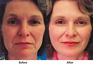 Botox in Los Altos CA: Reveal Reliable Wrinkle Reduction Magic