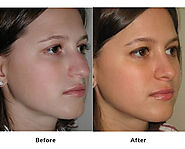 Scarless Rhinoplasty in Los Altos and San Jose for Natural Nose Reshaping