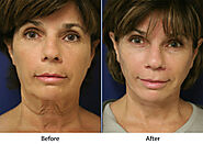Mittelman Horizontal Neck Lift- top facial plastic surgeon, San Jose