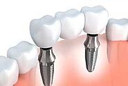 Painless Dental Implants in India | Tooth Implant Cost & Benefits