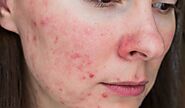 Fungal Acne Treatment at Home: Effective Remedies for Clear Skin | Best Review Todays