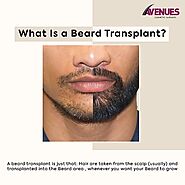 What Is Beard Transplant?